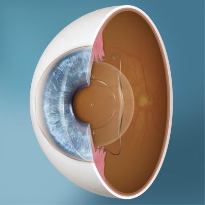 Laser Vision Correction